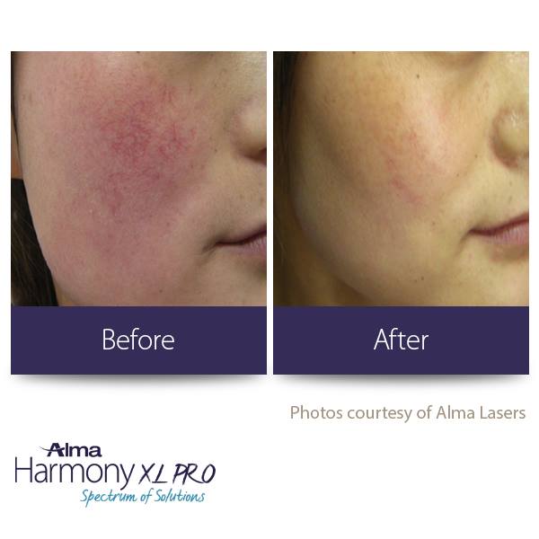 clinica yiara laser Harmony XL PRO