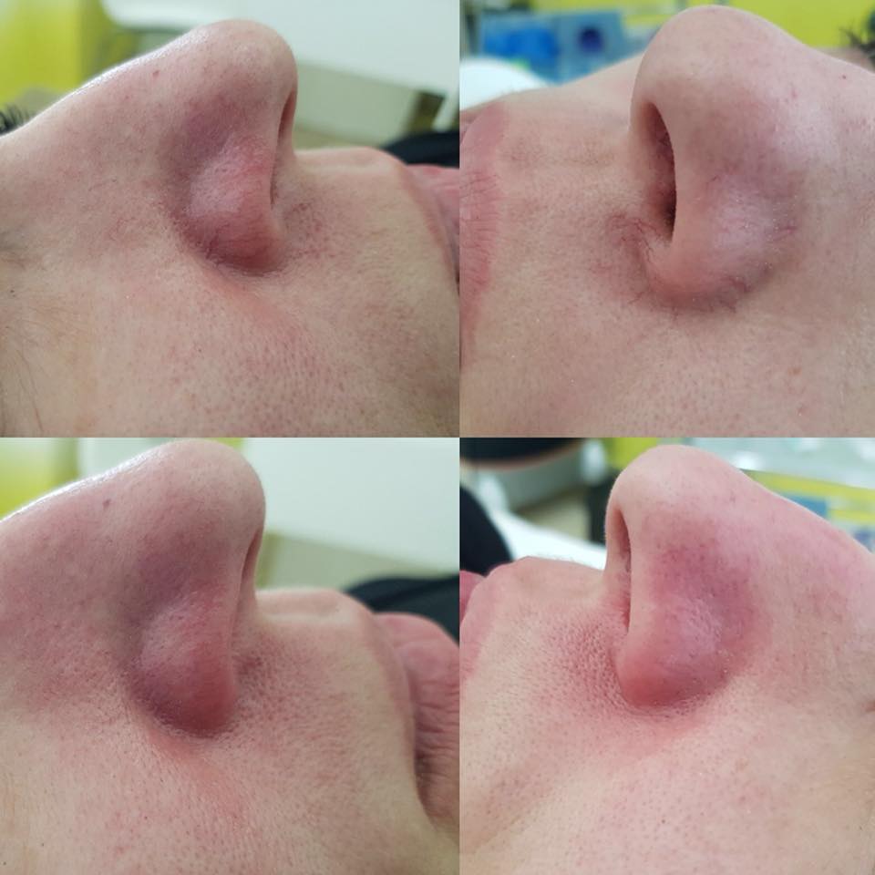 laser Harmony XL PRO clinica yiara vinisoare