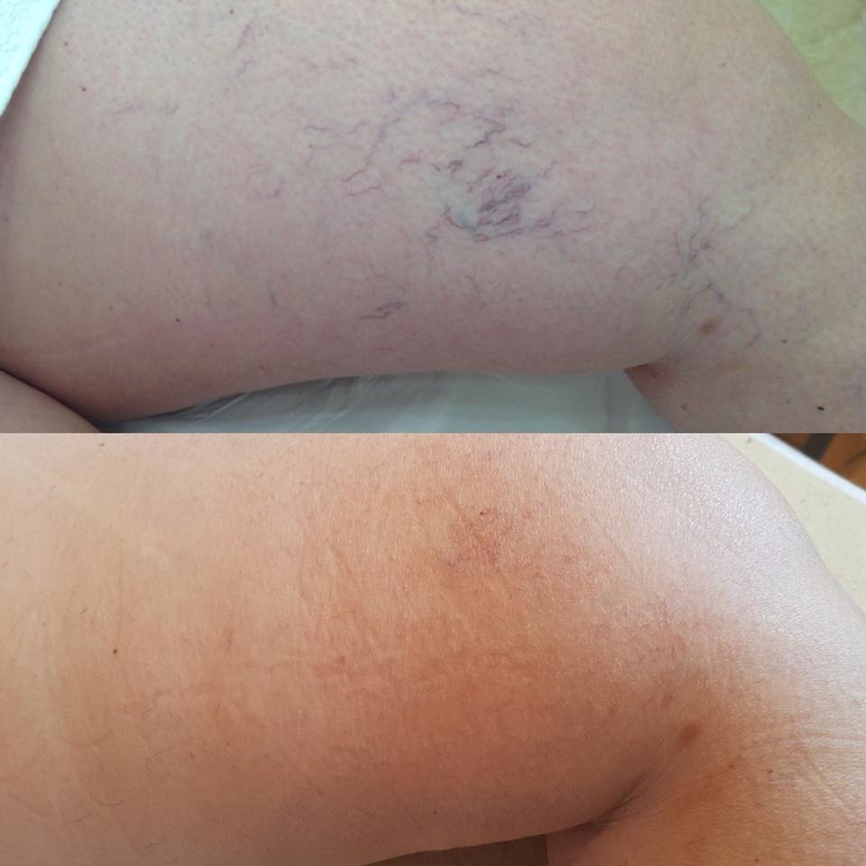 leziuni vasculare laser Harmony XL PRO clinica yiaraî
